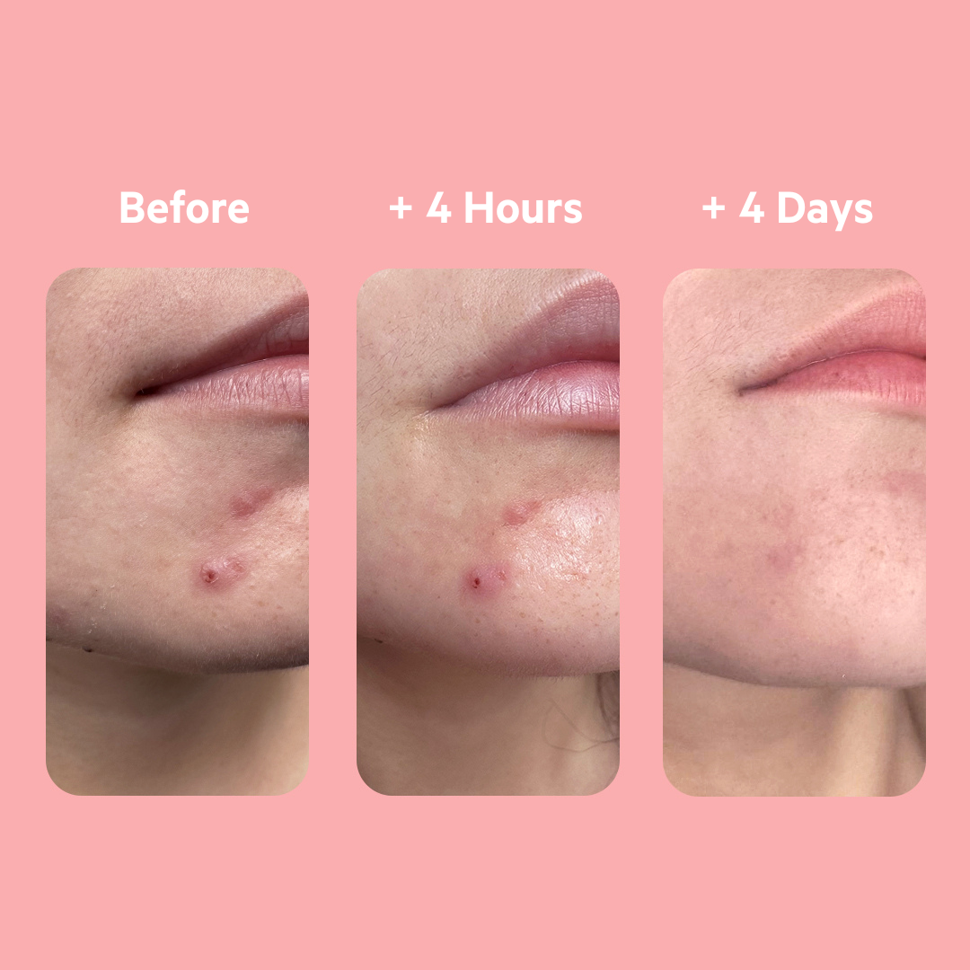 SEBIACLEAR 4hr Gel Flash 15ml