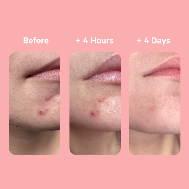 SEBIACLEAR 4hr Gel Flash 15ml